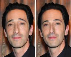 Adrien Brody before surgery